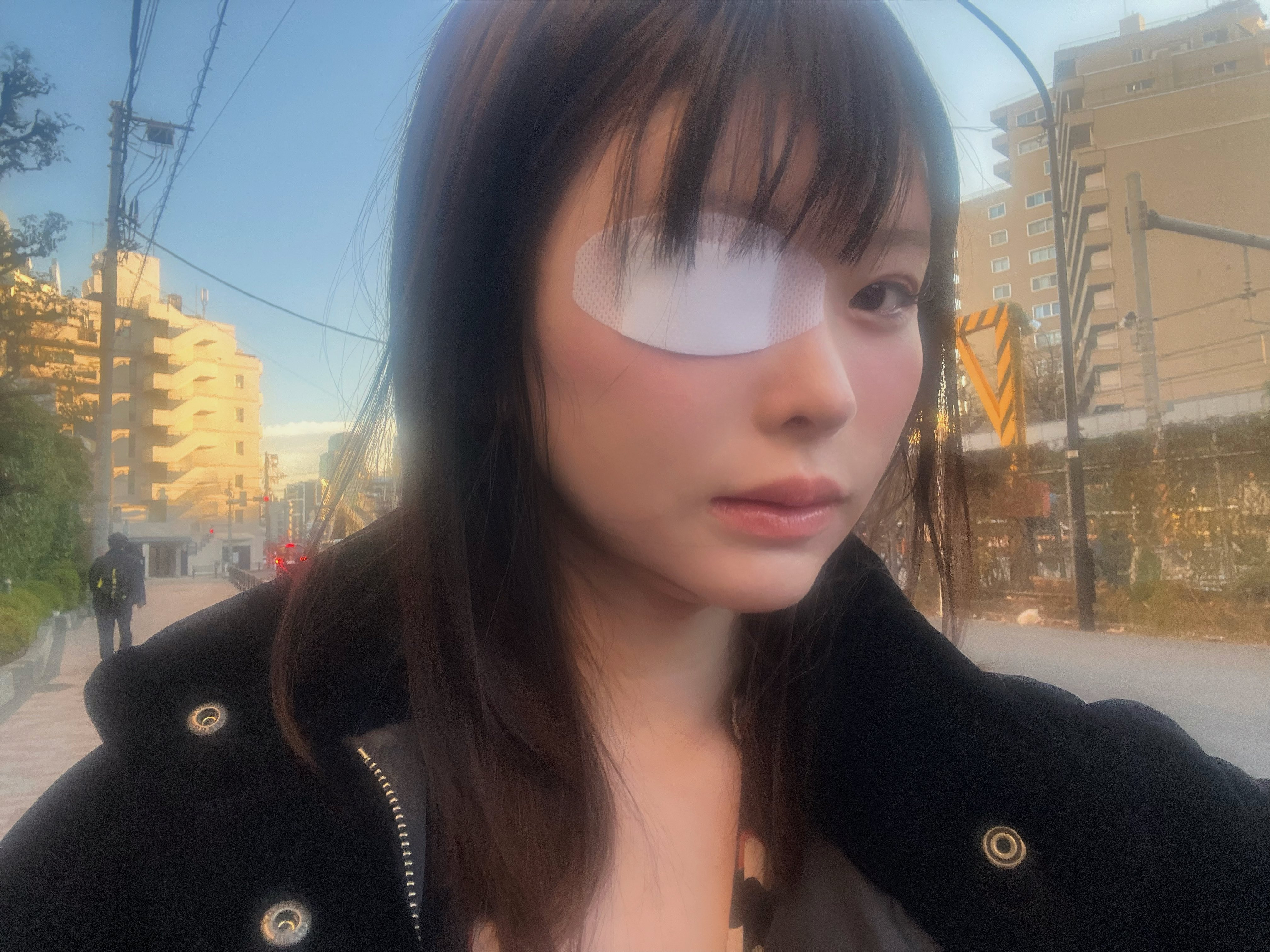 變成獨眼龍！松本麗鈴(原 明日見未来)被前男友打到受傷。